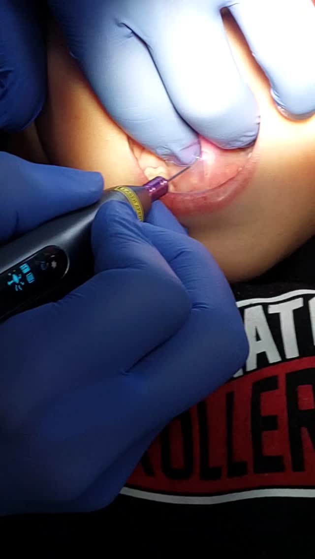 Лазерное лечение